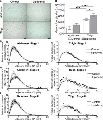 Lipedema stage affects adipocyte hypertrophy, subcutaneous adipose tissue inflammation and interstitial fibrosis
